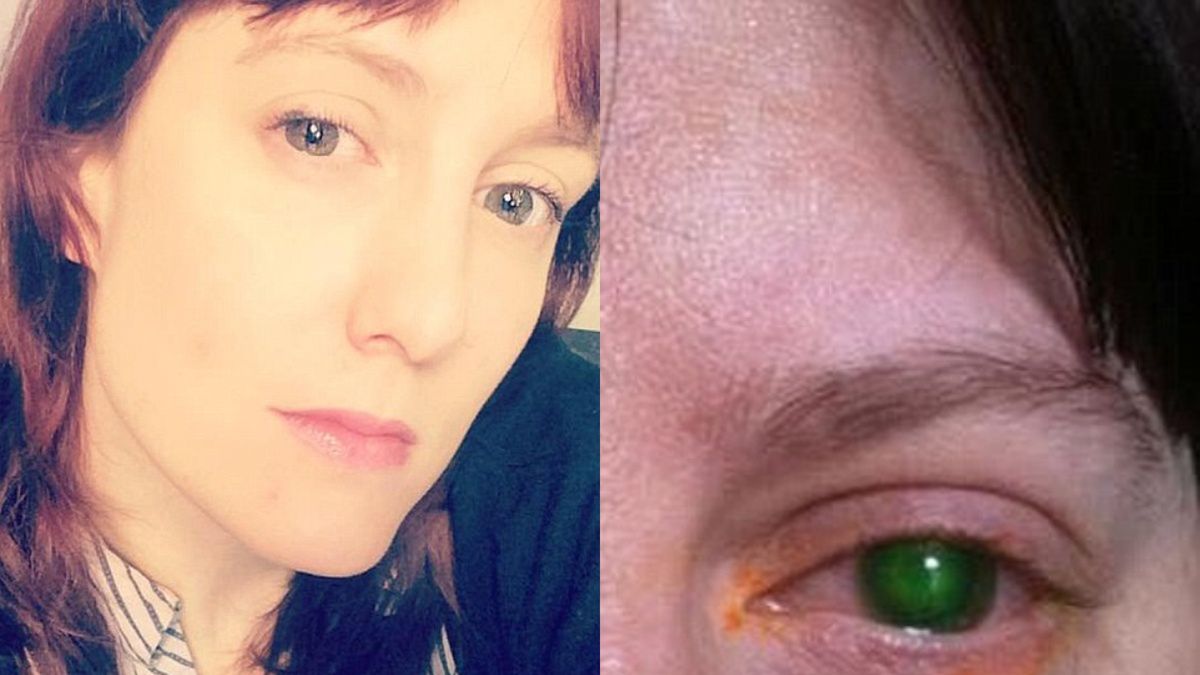 Konieczny okazał się przeszczep rogówki