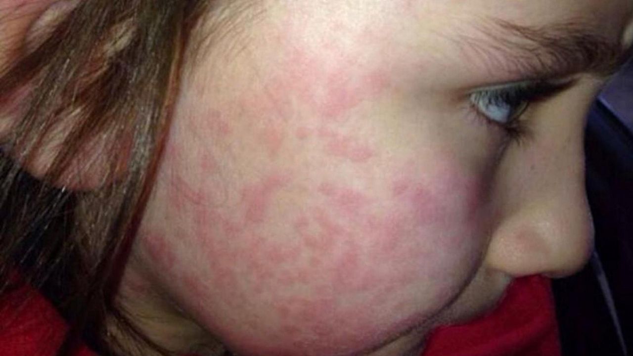 Długo czekała na diagnozę. Okazało się, że jest uczulona na zimno