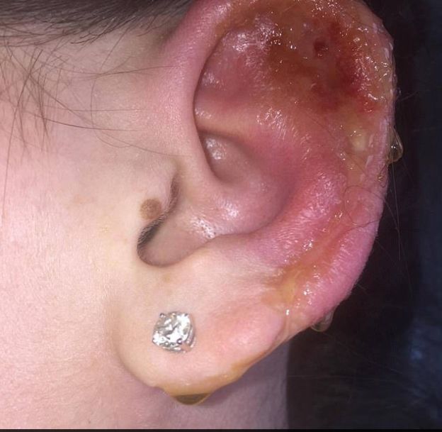 Dziewczyna chciała przekłuć swoją chrząstkę w uchu