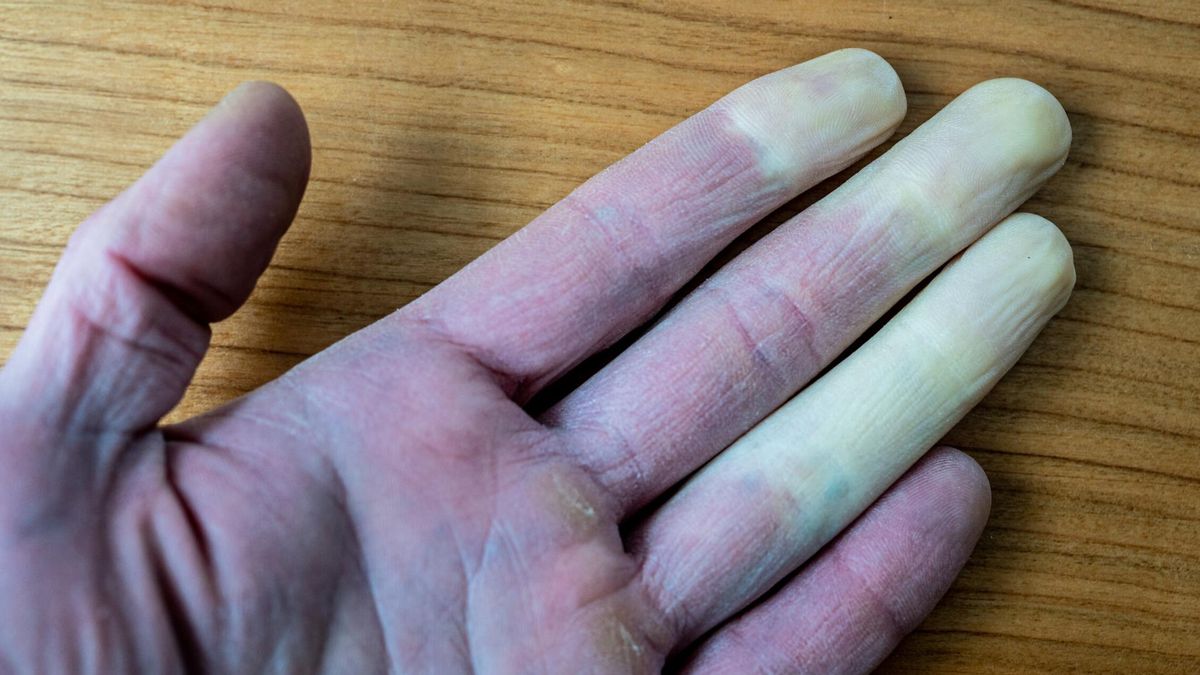 Objaw Raynauda "aktywuje się" na mrozie - ale także przez stres