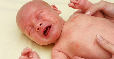 Wysypka u dziecka i niemowlaka - pokrzywka alergiczna, gorączka trzydniowa, różyczka, odra, ospa, trądzik, potówki