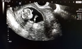 Ciąża bliźniacza u noworodka. Taki przypadek zdarza się raz na pół miliona porodów