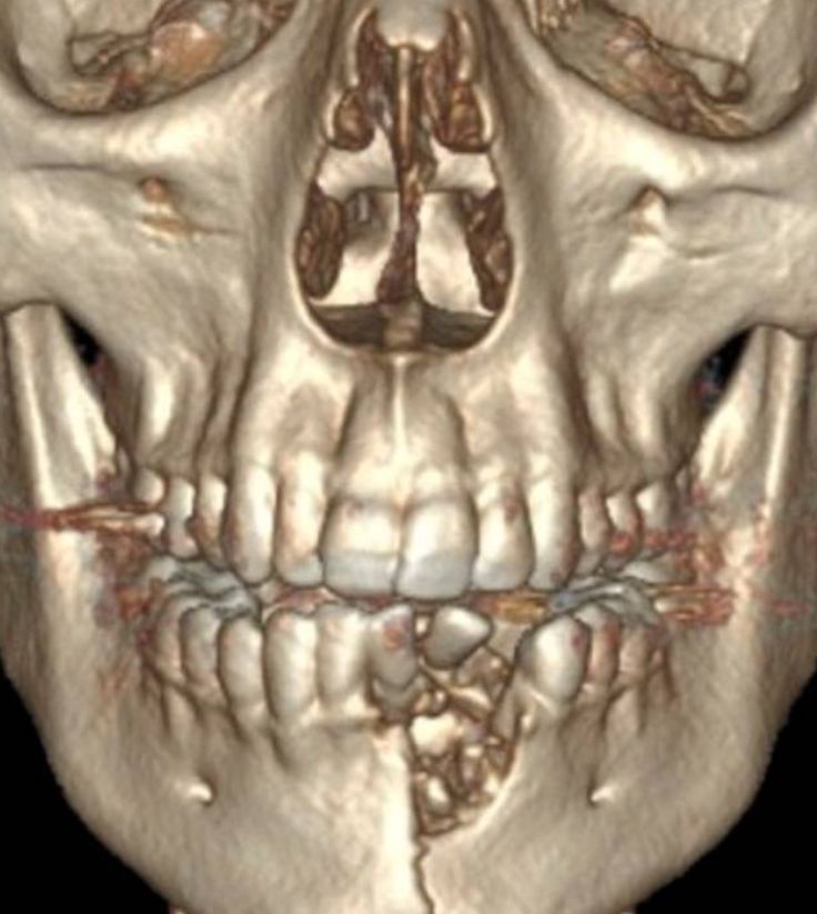 Po wybuchu e-papierosa pacjent stracił część zębów i doznał uszkodzeń szczęki i podbródka 