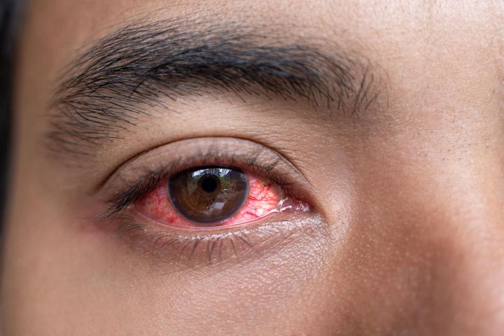 Czynniki ryzyka zespołu suchego oka