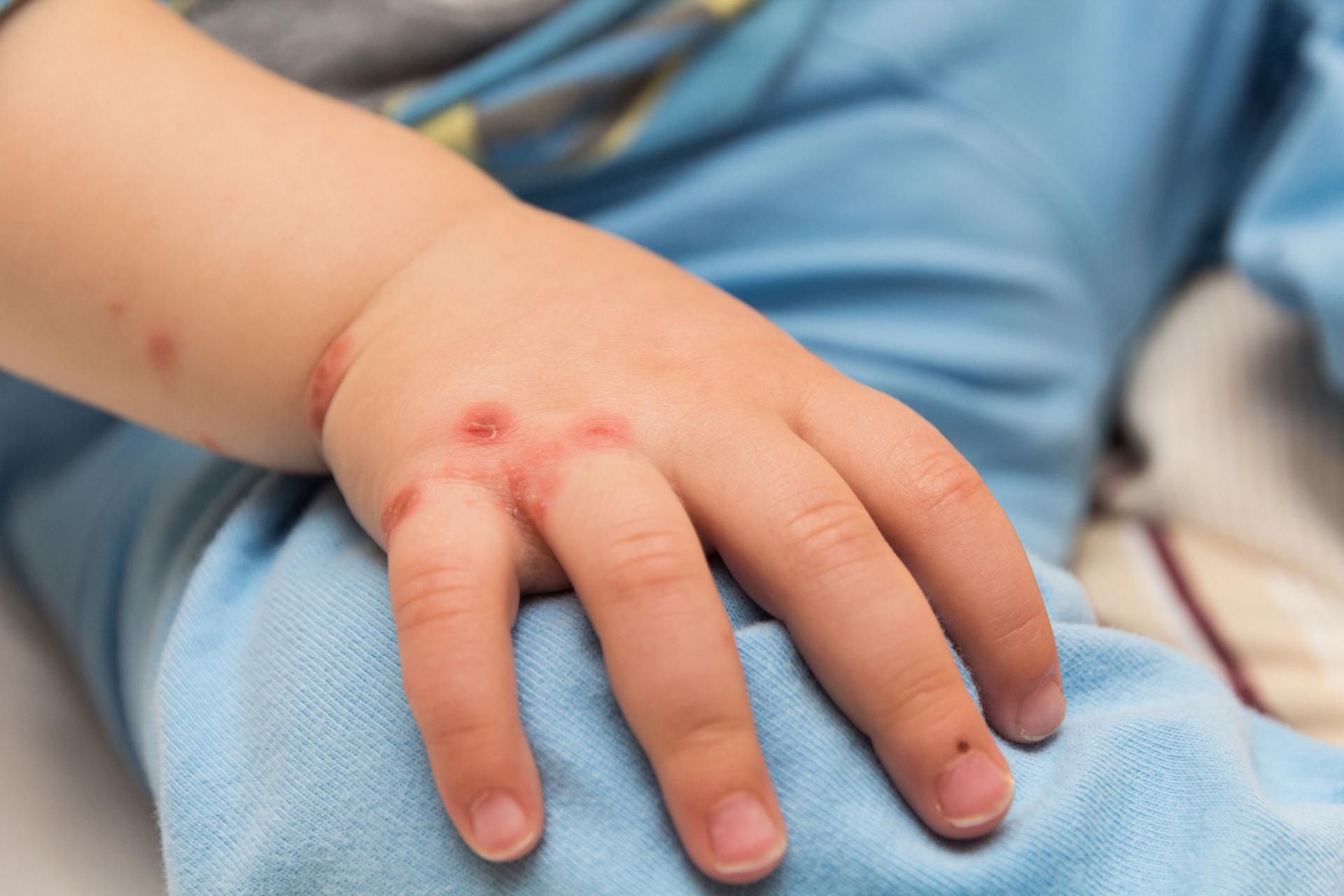 Podczas AZS należy używać odpowiednich kosmetyków