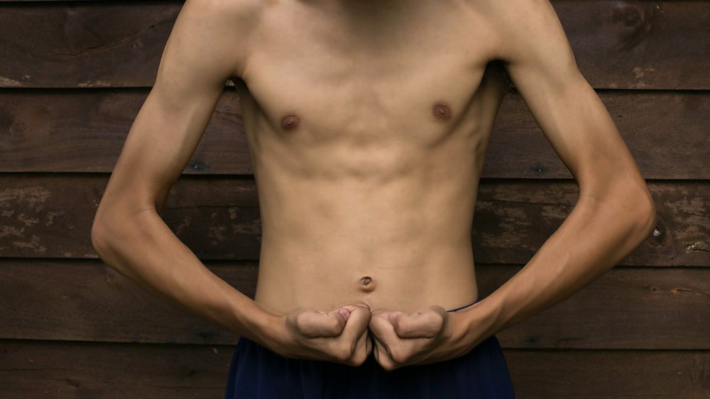 Każdy może zachorować na anoreksję