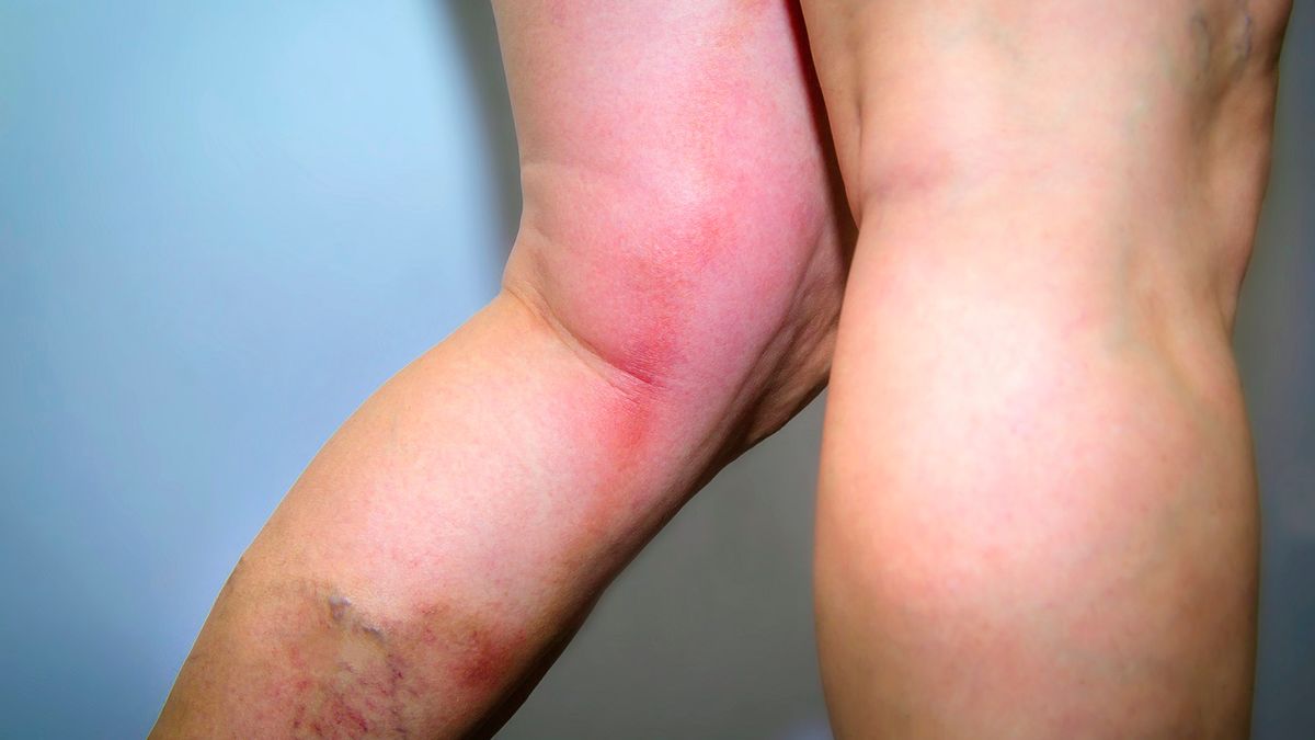 Jak obniżyć d-dimery?