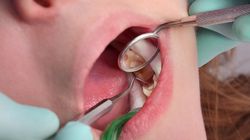 Dziura w zębie - czym jest, leczenie, zapobieganie