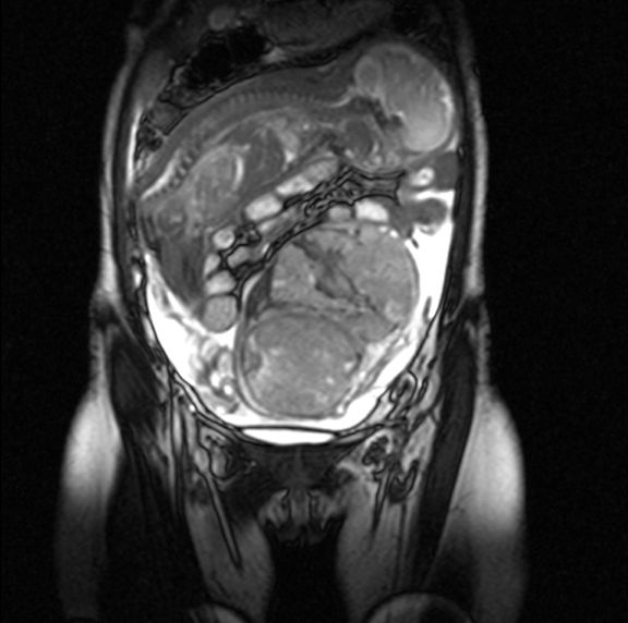 Płód rozwijał się w jelicie