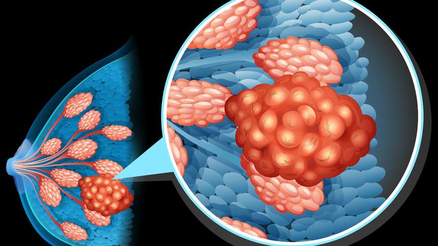 Wczesne wykrycie raka piersi zwiększa szanse na wyleczenie