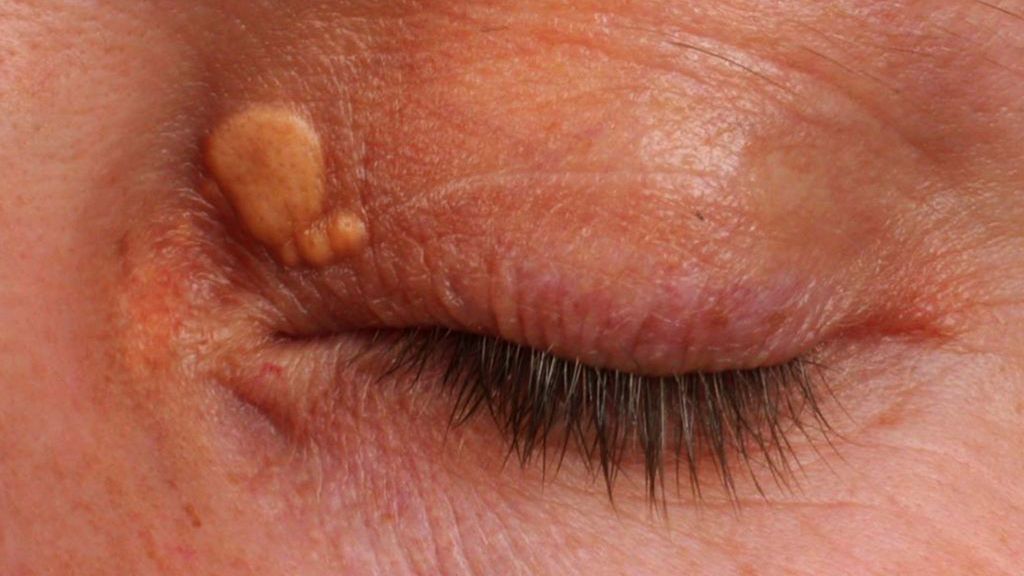 Tak objawia się wysoki cholesterol na twojej twarzy