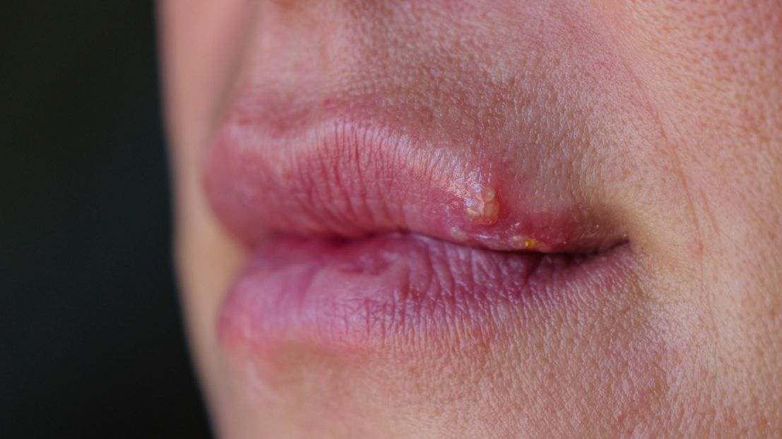 Opryszczka a pryszcz na ustach – jak je odróżnić?