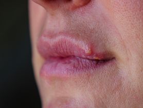 Opryszczka a pryszcz na ustach – jakie je odróżnić i leczyć?