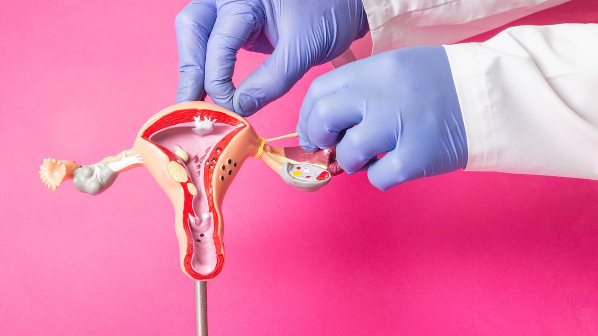 Podwiązanie jajowodów to trwała metoda antykoncepcji.