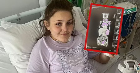 Pociła się w nocy i swędziała ją skóra. Lekarze ignorowali u 12-latki główne objawy raka