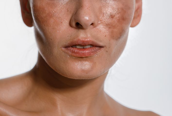 Przebarwienia skóry są powszechnym problemem dermatologicznym.