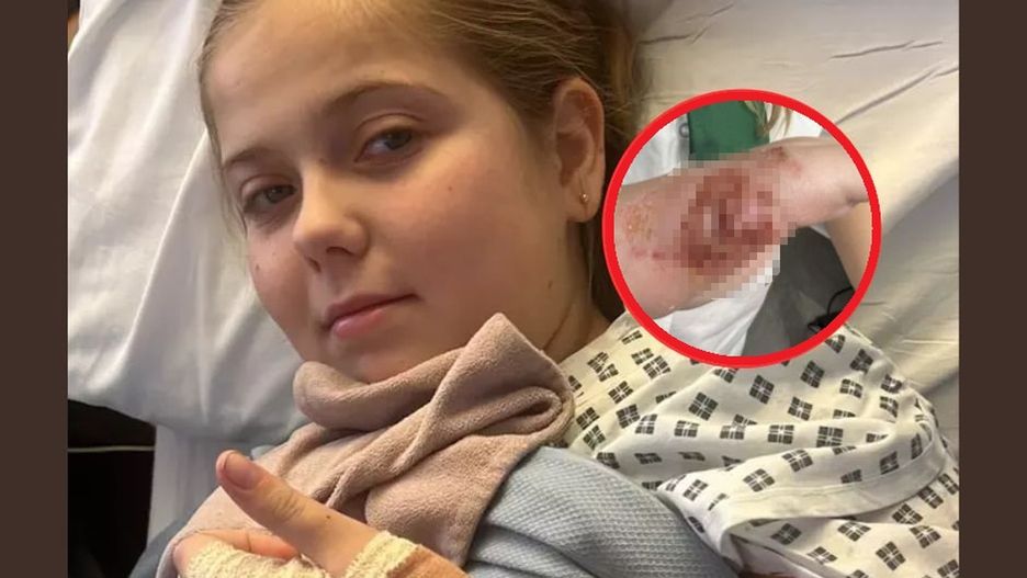 11-latka została oszpecona przez produkt kupiony w sieci. Lekarze: to najgorszy rodzaj oparzenia