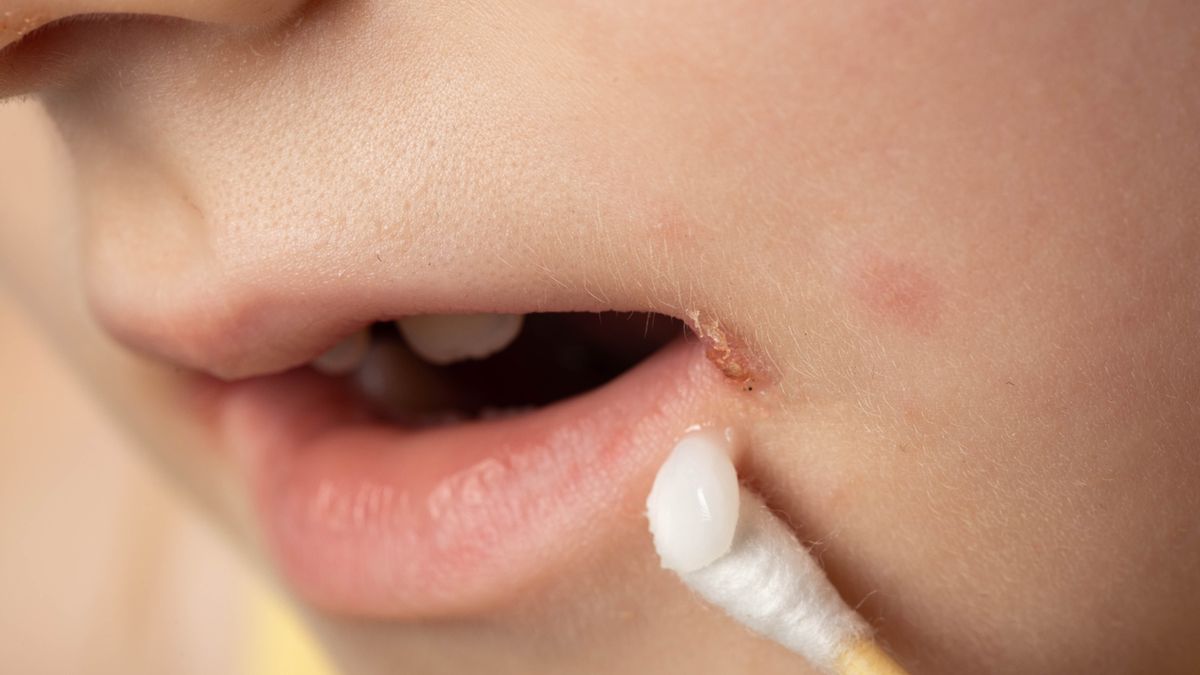 Liszaj u niemowląt manifestuje się w postaci asymptomatycznej wysypki