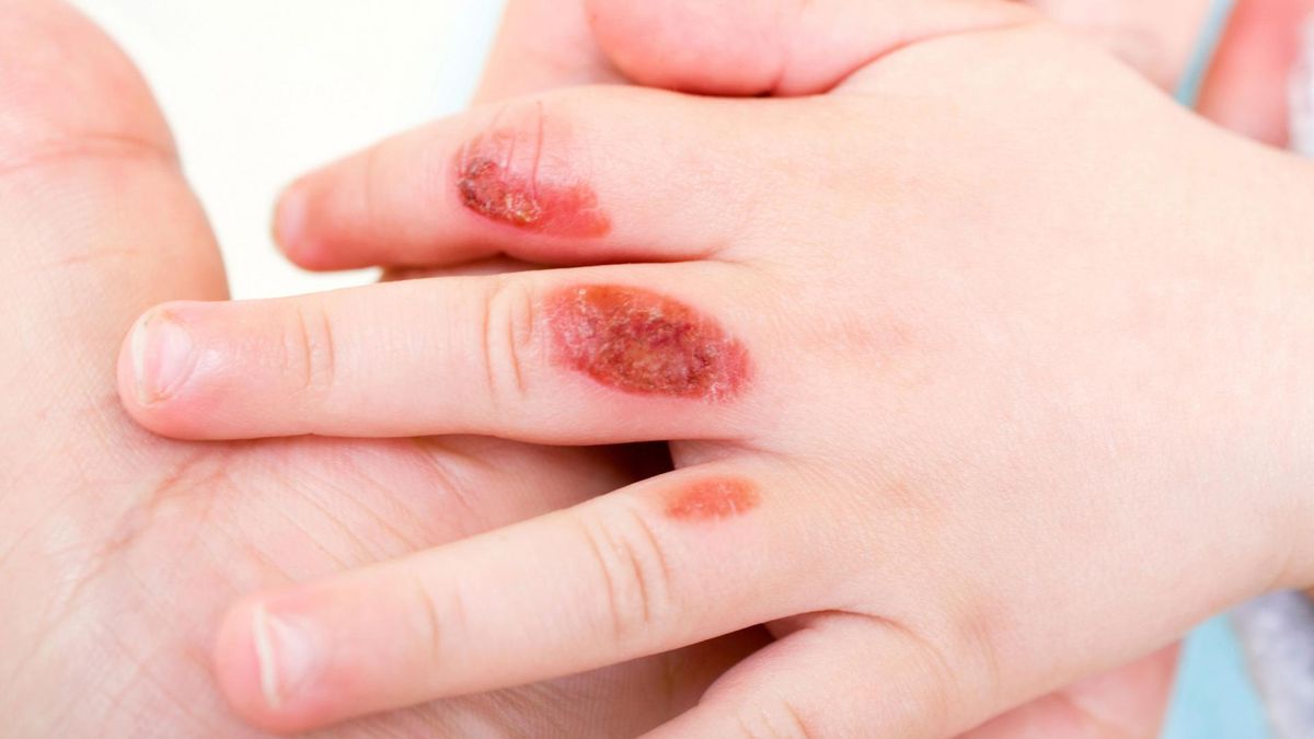 Dziecko poparzone wodą z węża ogrodowego