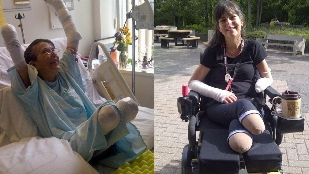 Po ugryzieniu psa amputowano jej nogi i rękę. Miała sepsę