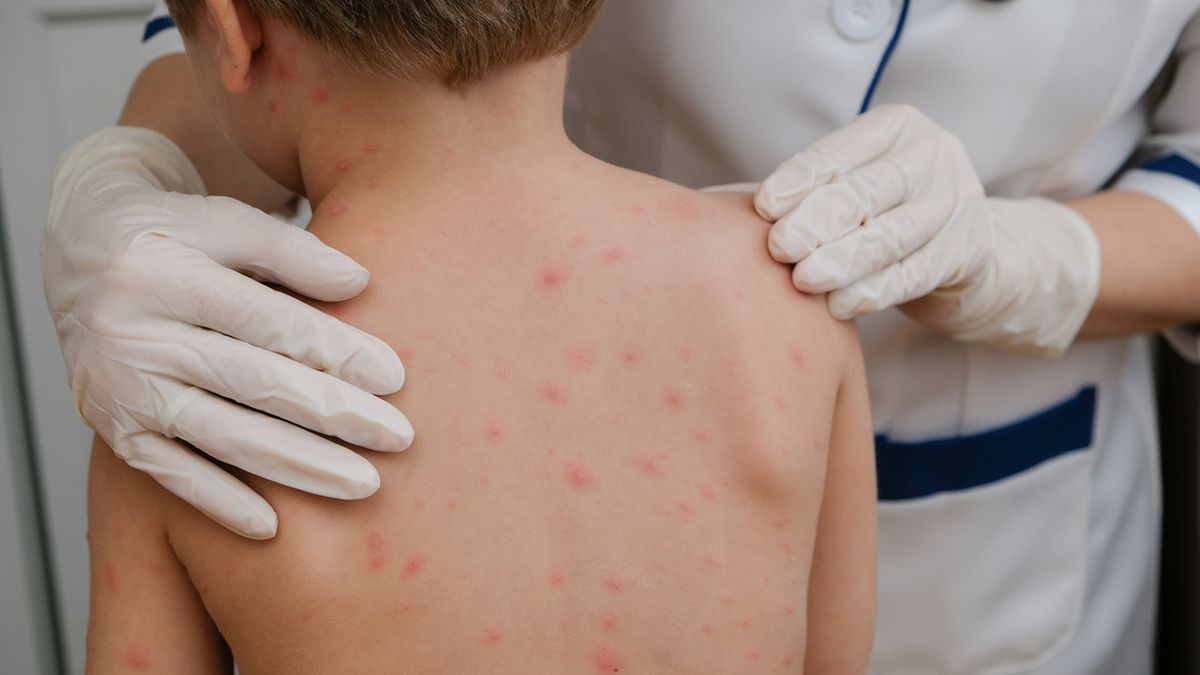 Varilrix to wydawana na receptę szczepionka przeciwko ospie wietrznej.