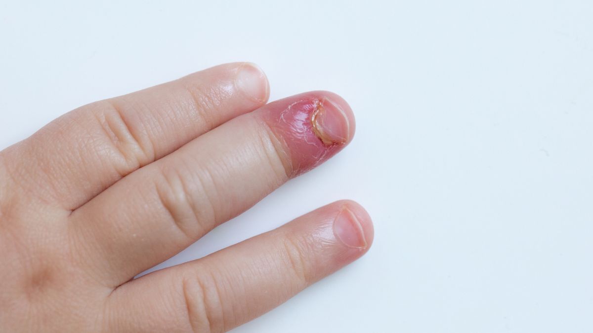 Zastrzał palca może być wynikiem obgryzania paznokci