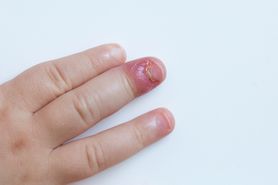 Zastrzał palca a niewłaściwa pielęgnacja paznokci. Domowe sposoby na ropne zapalenie palca