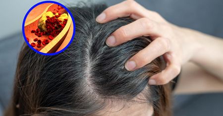 Objaw zauważysz na głowie. Znak, że cholesterol zapycha tętnice