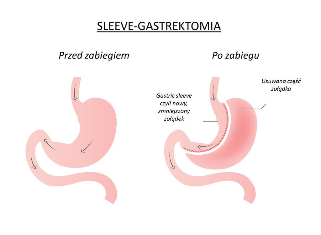 Gastrektomia