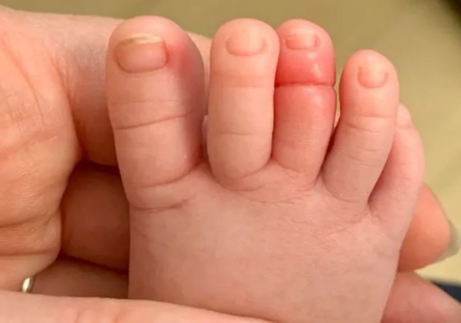 Zespół opaski włosowej może być bardzo groźny