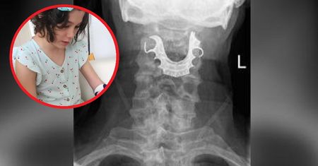 10-latka spadła z łóżka. Prześwietlenie ujawniło straszną prawdę