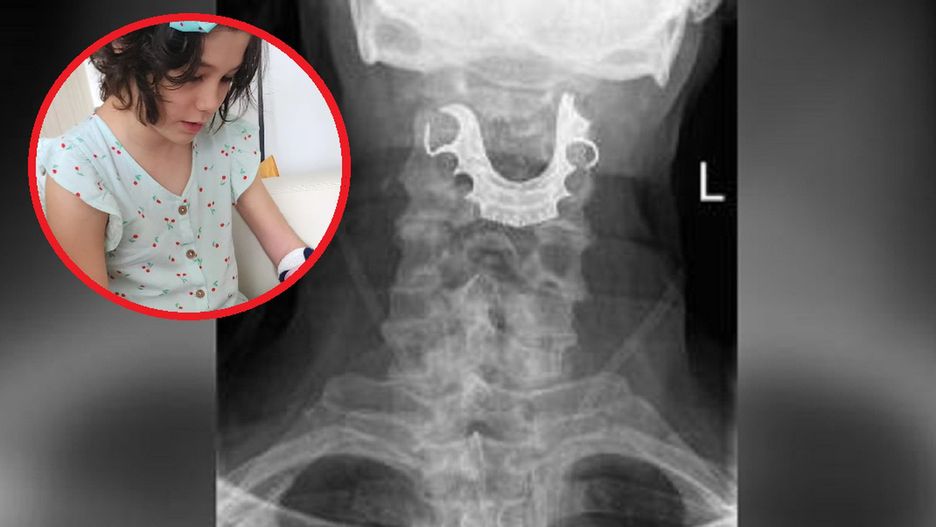 Dziewczynka spadła z łóżka. Prześwietlenie ręki wyjawiło straszną prawdę