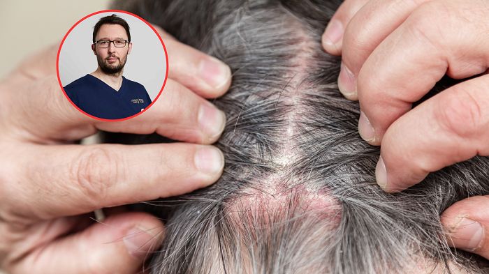 Dewastuje narządy, uszkadza serce i nerki. Groźną chorobę można dostrzec na włosach