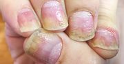 Objawy łuszczycy na paznokciach. Nie ignoruj takich zmian