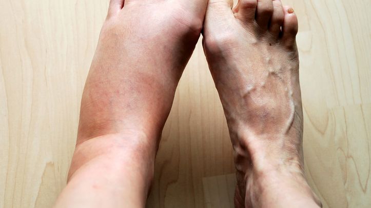 Opuchlizna może świadczyć o rozwoju zakrzepicy. Zwłaszcza jeśli pojawia się tylko na jednej nodze i nie znika mimo odpoczynku