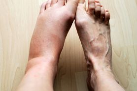 Opuchlizna na nogach nie musi być związana z upałem. Jakie mogą być przyczyny?