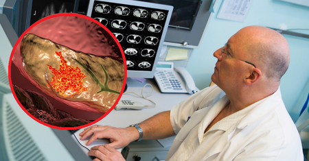 Odkrycie w diagnostyce raka trzustki: Wykrywanie zmian przednowotworowych za pomocą MRI