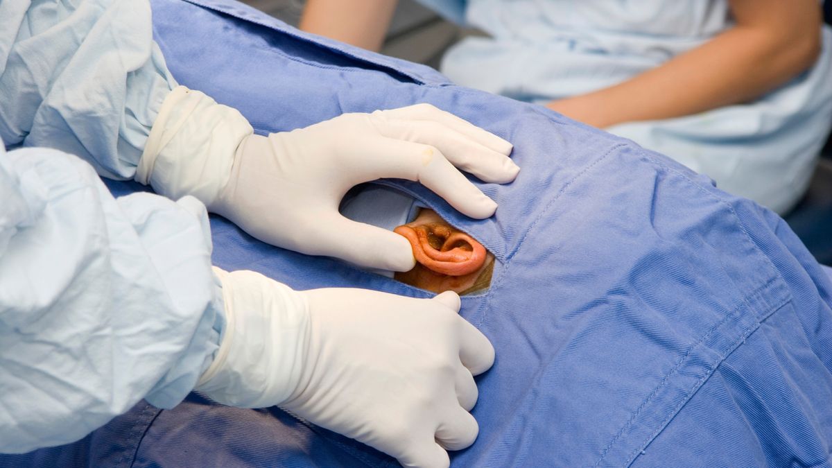 Ossikuloplastyka polega na rekonstrukcji łańcuszka kosteczek słuchowych