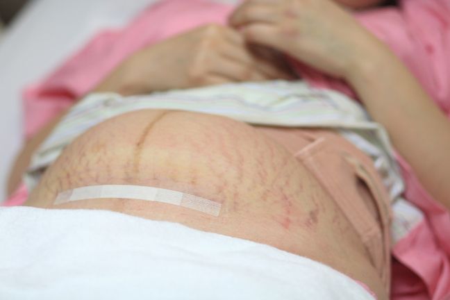 Obecnie podczas cesarskiego cięcia praktykuje się wykonanie poziomego nacięcia w dole brzucha przyszłej mamy. Dzięki temu, po zagojeniu się, blizna jest mniej widoczna