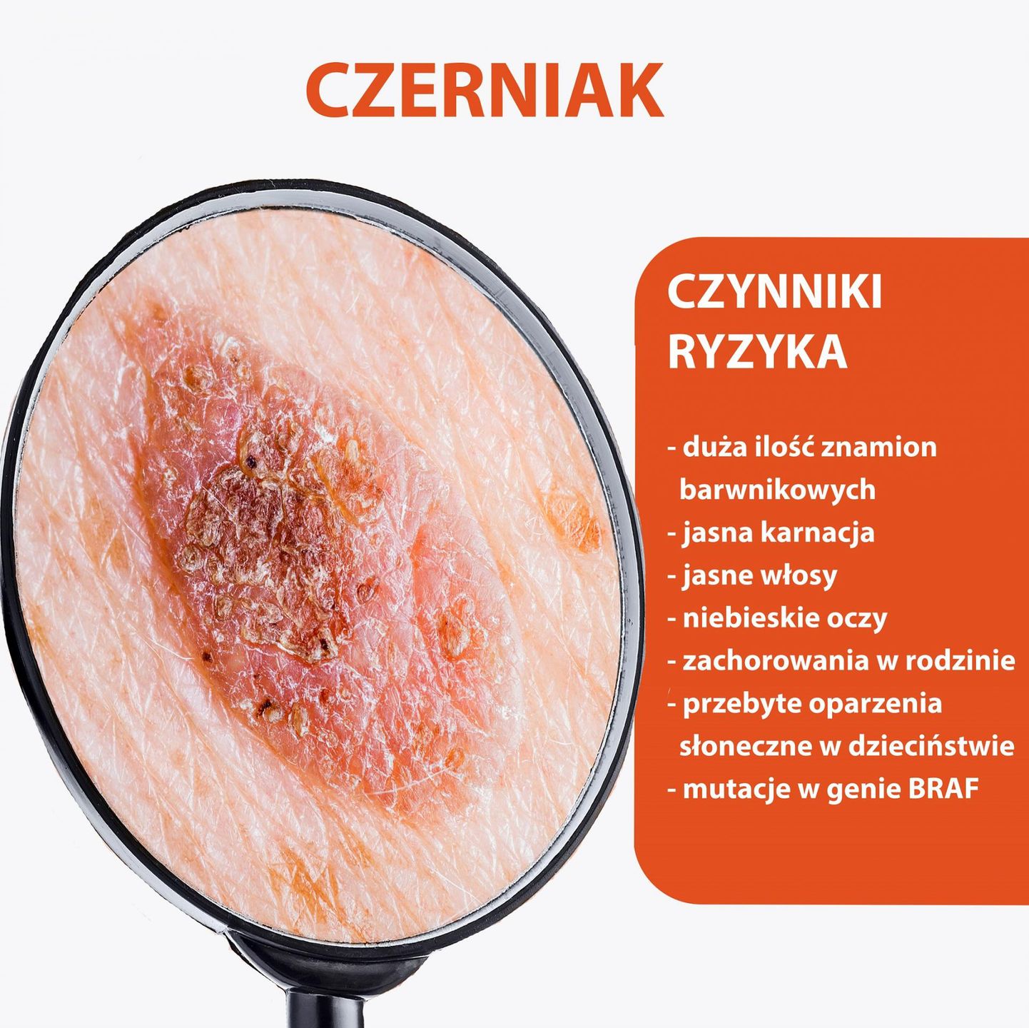 Czynniki zwiększające ryzyko rozwoju czerniaka 