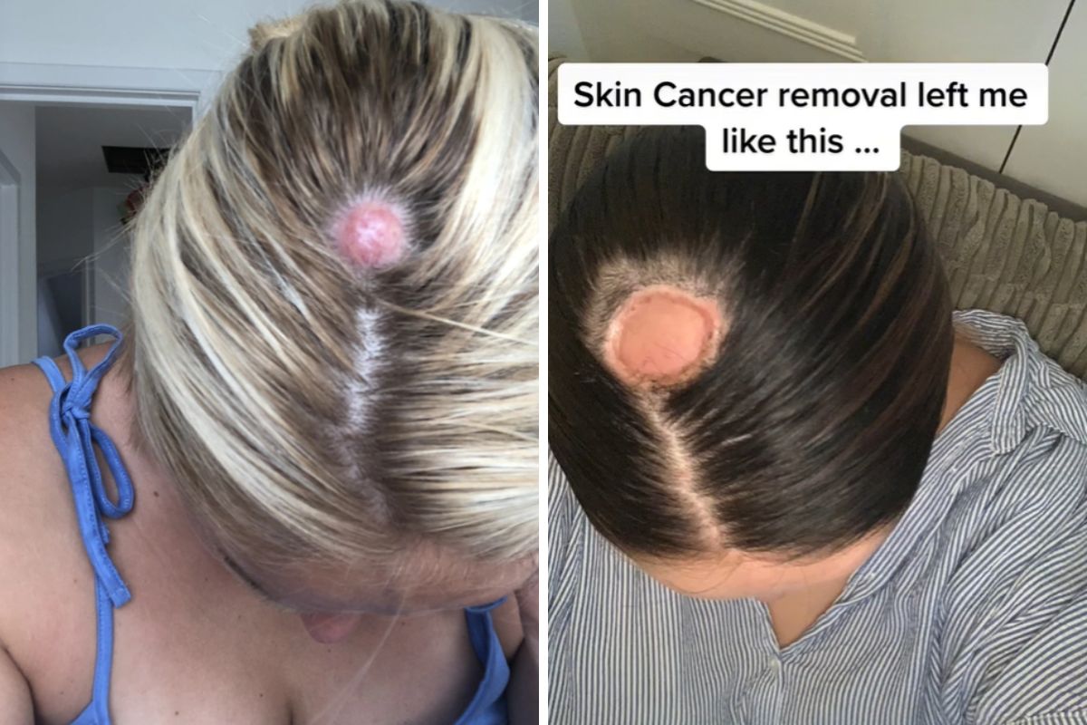 Z niewielkiej łysiny na głowie aż po &quot;krater&quot;