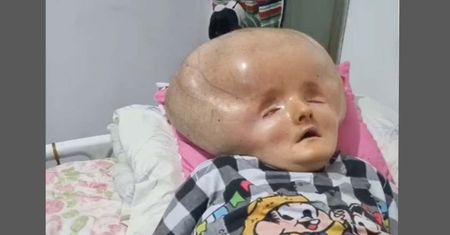 Jej głowa powiększyła się trzykrotnie. Od lat jest przykuta do łóżka