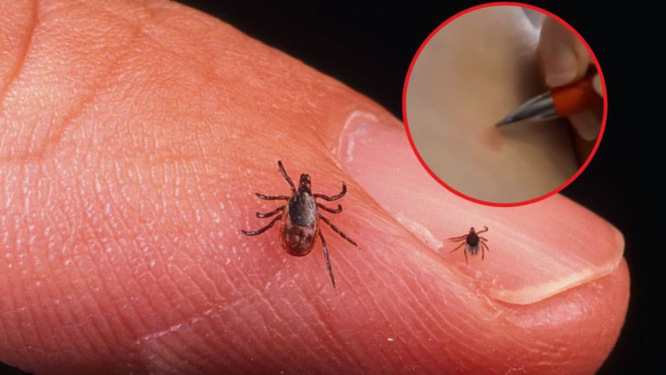 Trik z długopisem. Pomoże przy ukąszeniach