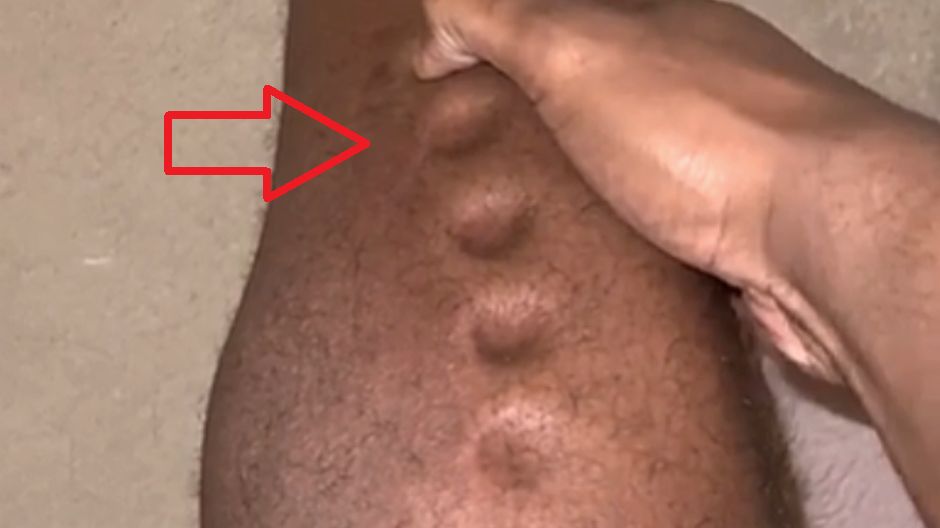 Sportowiec zmagał się z zapaleniem tkanki łącznej