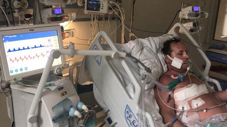 Zdrowe płuca dawcy w trakcie przygotowania do przeszczepienia 