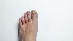 Żółte paznokcie u nóg - grzybica stóp, pałeczka ropy błękitnej