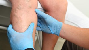 Zakrzepica zabiera co czwartego chorego. Eksperci mówią, jak jej uniknąć