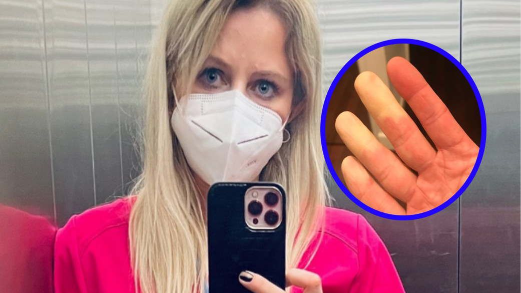 Nagłe blednięcie i sinienie palców może zwiastować poważne choroby