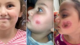 Otrzymała "pocałunek śmierci". 4-letnia dziewczynka trafiła do szpitala