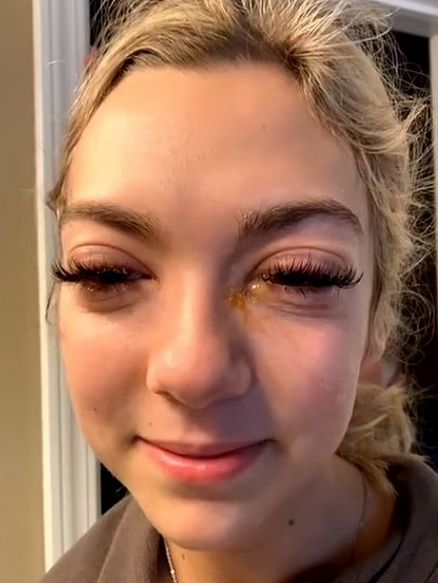 Oczy były bardzo spuchnięte